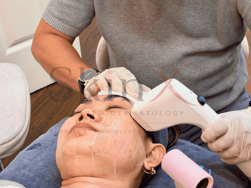 Sofwave giúp nâng da một cách nhẹ nhàng, giúp da săn chắc hơn